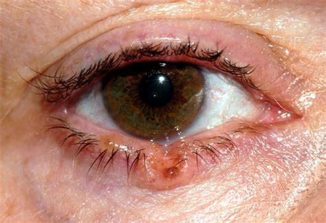 Symptoms Of Eye Cancer