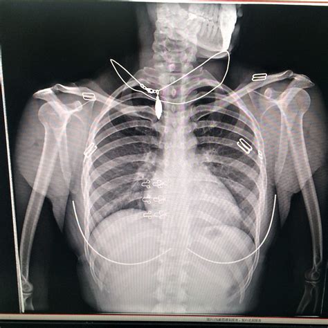 Booklet Pneumonia Normal Chest X Ray Female