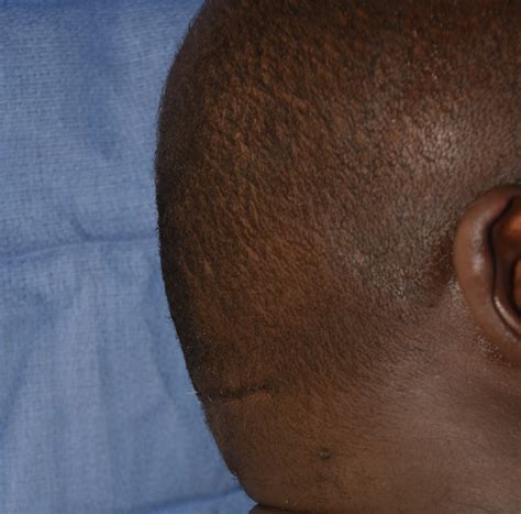 Occipital Skull Reduction With Scalp Tuck Right Side After Dr Barry