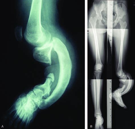 A B Pre Operative X Ray Film Of The Affected Leg Download