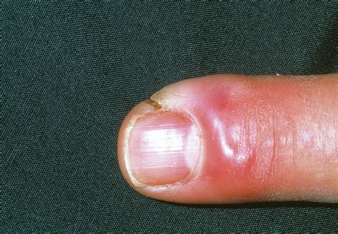 Cellulitis Infection On A Finger Photograph By Dr P Marazziscience
