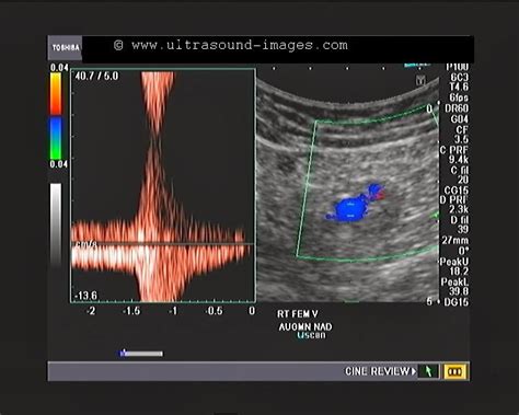 Cochinblogs Normal Lower Limb Venous Doppler Study Using Convex Probe