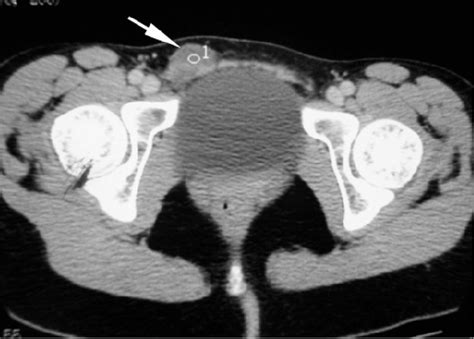 Ct Scan Demonstrating A Lobular Cystic Mass In The Inguinal Canal