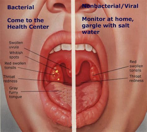 All You Need To Know About A Strep Throat Hubpages