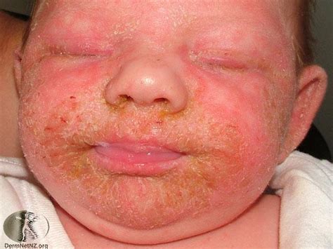 Seborrheic Dermatitis In Children National Eczema Association