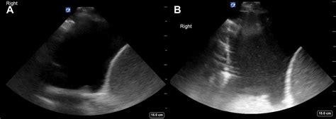 Loculated Pleural Effusion Ultrasound Lung Ultrasound In Children