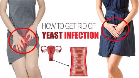 How To Treat Yeast Infection Naturally Home Remedies For Yeast Infection Youtube