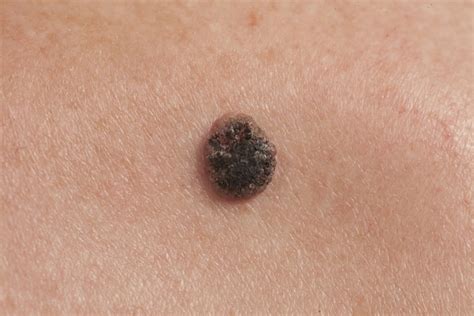 Skin Cancer Moles Skin Cancer Mole Mole Skin Cancer P