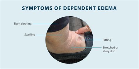 Dependent Edema Symptoms Causes Treatment And More Tactile Medical