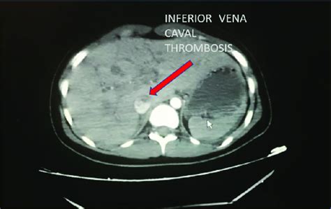 Observation Of Inferior Vena Caval Thrombosis In Computed Tomography