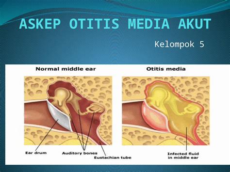 Pptx Ppt Askep Otitis Media Akut Pdfslidenet