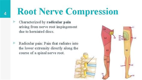 Loading Classic Nerve Root Impingement In The Neck Pl