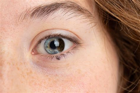 Heterocromia Um Distúrbio Que Torna Os Olhos De Cores Diferentes