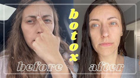 My Botox Experience Days 1 6 Youtube