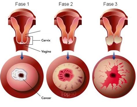 En la etapa inicial, el cáncer de cuello uterino suele tratarse con cirugía. 6 Sintomas de Cancer de Cuello Utero