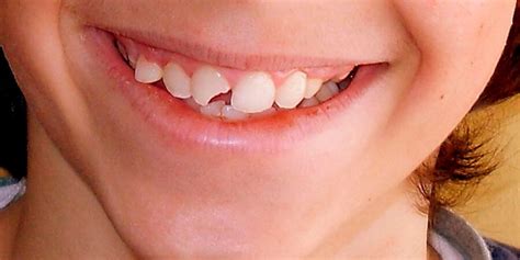Qué debemos hacer si se nos rompe un diente Clínica Dental Cubdens