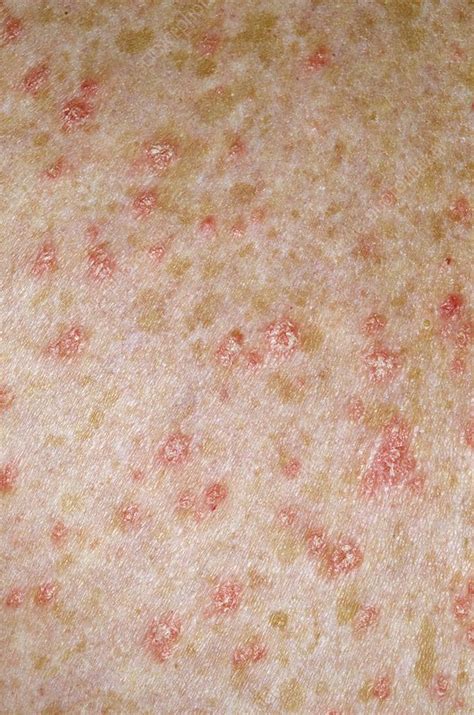 Guttate Psoriasis On The Skin Stock Image C0169274 Science Photo