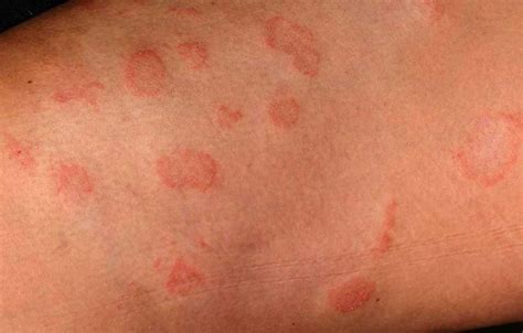 Pin By Jordan Lohrmann On Health Nummular Eczema Eczema Ringworm