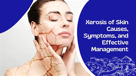 Xerosis Of Skin Causes Symptoms And Effective Management
