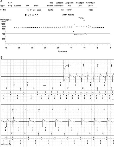 Remote Monitoring Data Of Non Sustained Ventricular Tachycardia In A