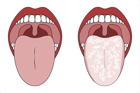 Thrush In Mouth In Adults Medication Draw Hub