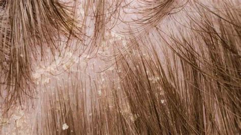 Useful Mild Treatment Solutions For Scalp Psoriasis Problem Smart