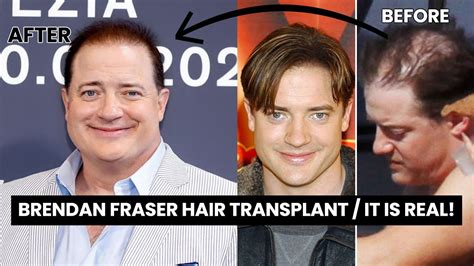 Brendan Fraser Hair Transplant It Is Real Celebrity Hair Transplant