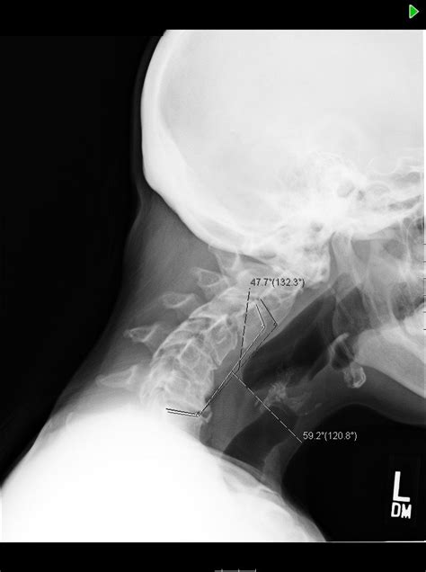 54 Yo Woman With Neuromuscular Condition And Cervical Scoliosis