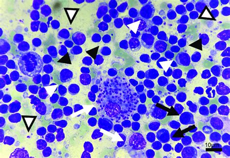 Micrograph From Lymph Node Cytology From Case 17 Note The Predominance