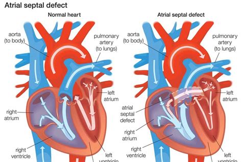 Procedures Point Atrial Septal Defect Asd
