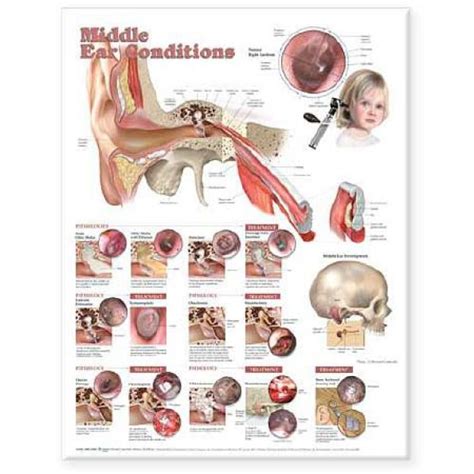 Anatomical Chart Middle Ear Conditions