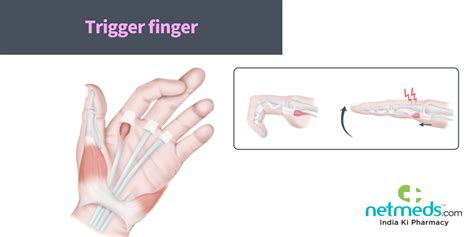 Trigger Finger Causes Symptoms And Treatment