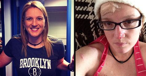 A Woman Who Was Addicted To Tanning Beds Had 86 Skin Cancer Surgeries