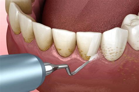 Periodontal Scaling And Root Planing San Ramon Ca Zen Smiles