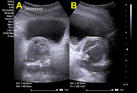 Cureus A Rare Case Of A Prostatic Abscess Secondary To A Mycoplasma