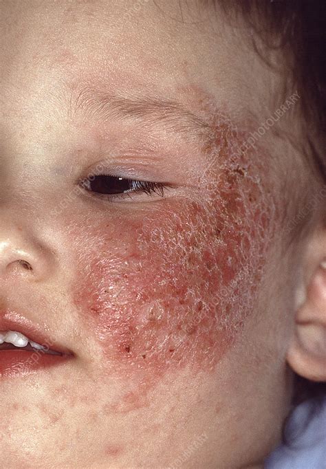 Atopic Dermatitis Stock Image C0509927 Science Photo Library