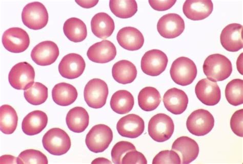 What Do Normal Red Blood Cells Look Like Pathology Student