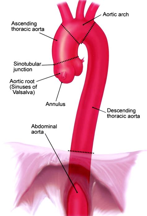 Ascending Aortic Aneurysm Aorta ©massachusetts General Hospital