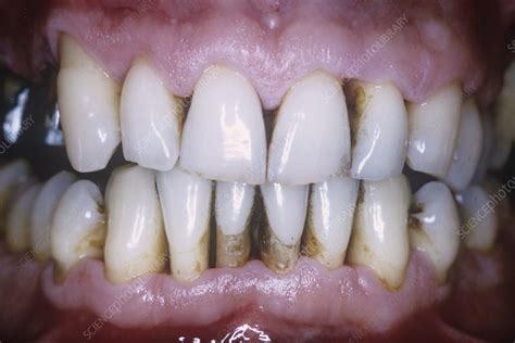 Receding Gums In Gum Disease Stock Image C0237582 Science Photo