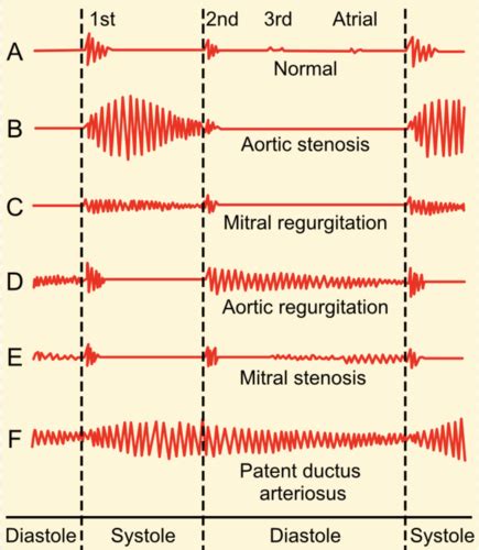 heart sounds and murmurs flashcards quizlet