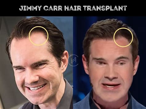 Jimmy Carr Hair Transplant Hair Loss Technical Analysis