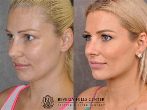 Laser Facelift Profound Microlift Before And Afters Beverly Hills