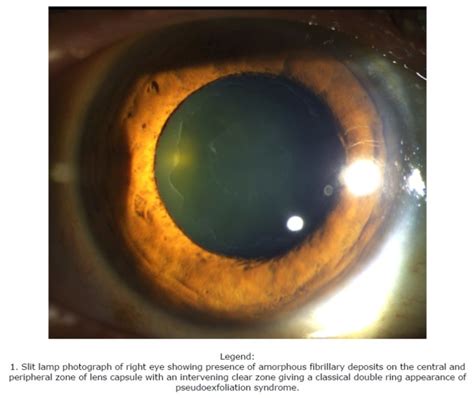 Slit Lamp Photograph Of Right Eye Showing Presence Of Amorphous
