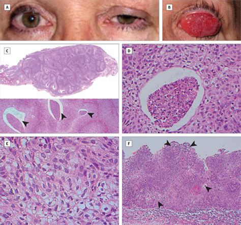 Squamous Cell Carcinoma With Clear Cell Features Of The Palpebral