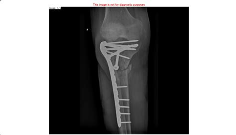 Nonunion Of Proximal Tibia Treated With Locking Compression Plate And