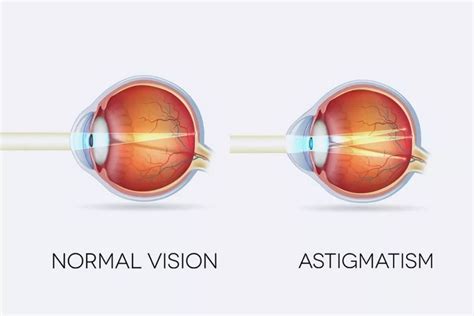 A Complete Guide To Astigmatism Symptoms Causes