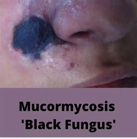 Mucormycosis Black Fungus Symptoms Preventive Tips Rnnursingexam