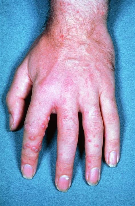 Shingles Rash On Hand Photograph By James Stevensonscience Photo Library