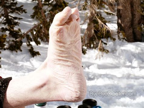 Trench Foot Pictures Symptoms Causes Treatment And Prevention Of Diseases