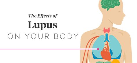 The Effects Of Lupus On The Body